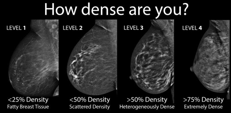 Symptoms of Dense Breast