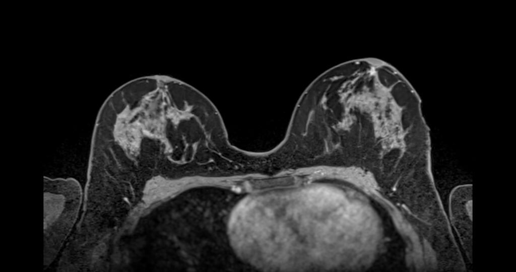 MRI scan of the breasts in an axial view with contrast enhancement, highlighting vascular structures and tissue composition. Used for breast cancer screening and diagnostic evaluation.