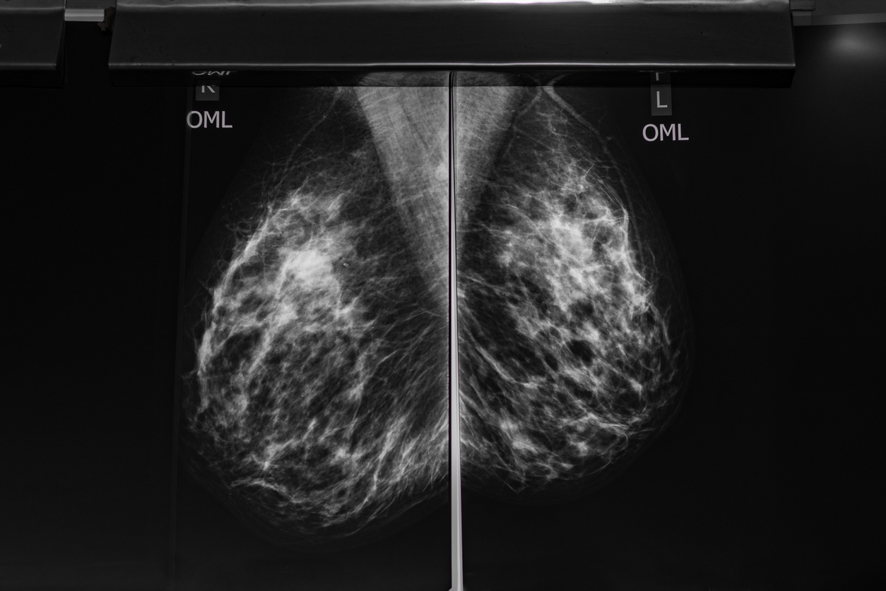 Detailed Medical Diagnostic Mammogram Black and White Scan Image